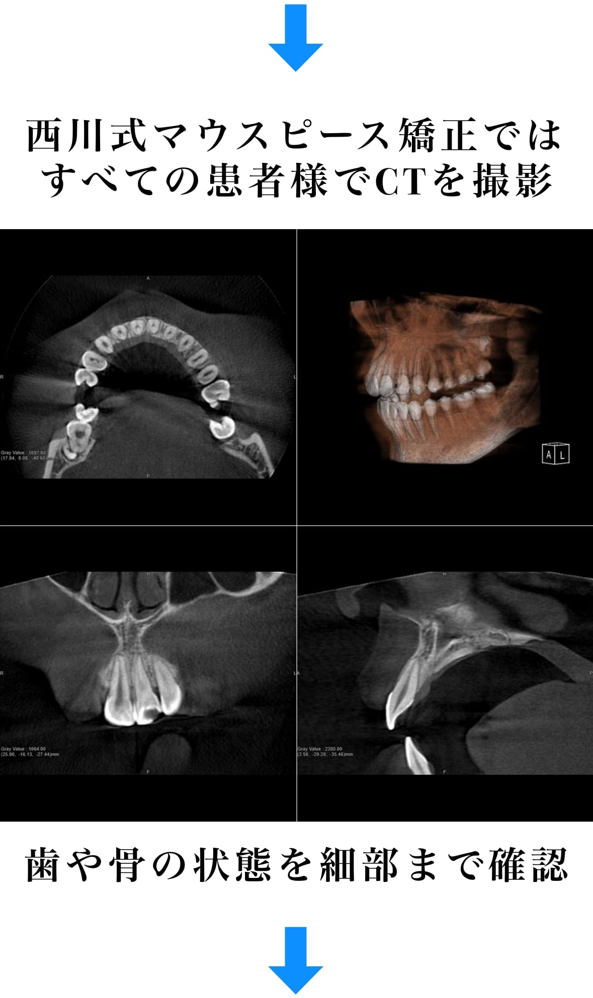 西川式マウスピース矯正では全ての患者様でCTを撮影。歯や骨の状態を細部まで確認