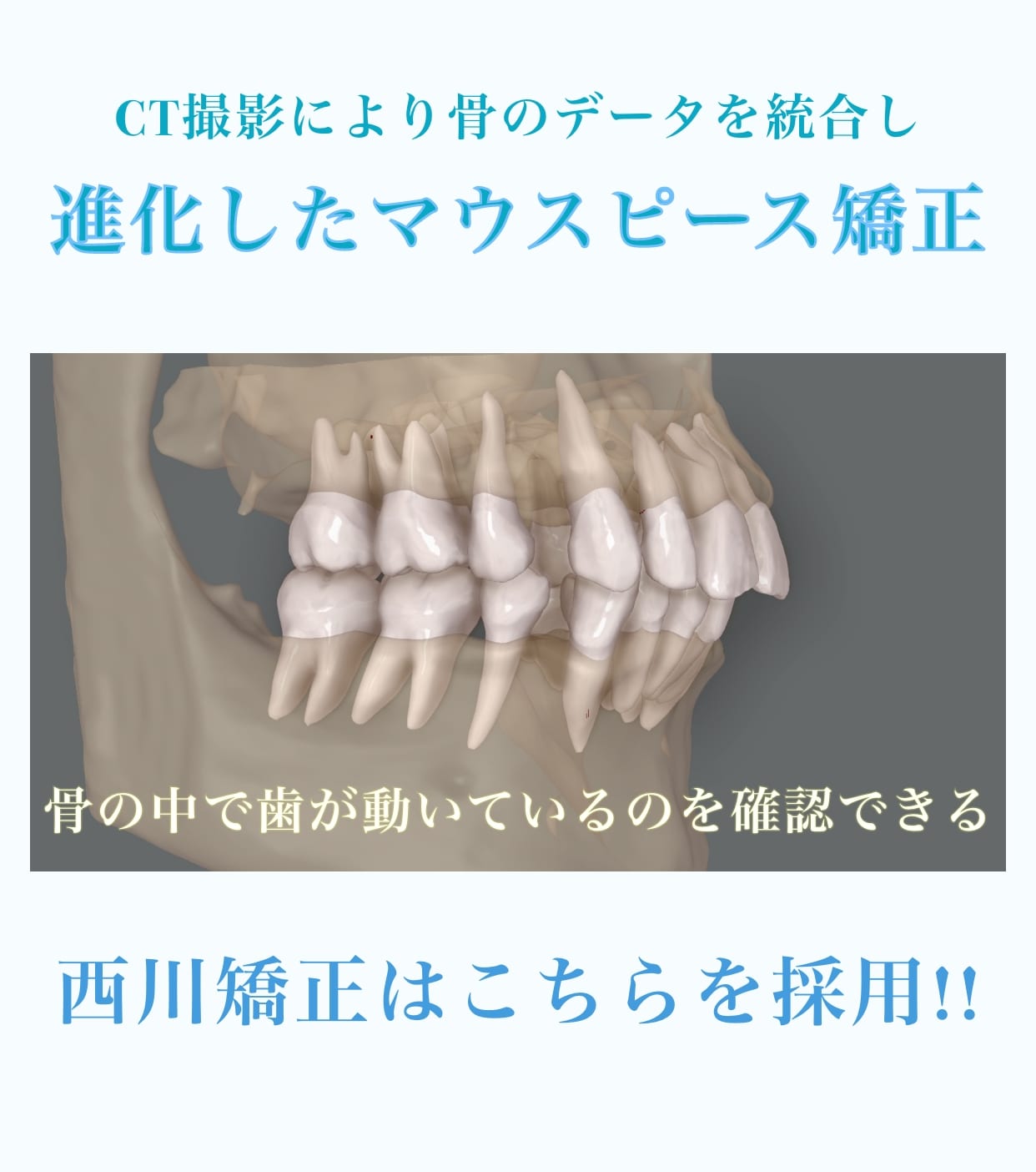 CT撮影により骨のデータを統合し進化したマウスピース矯正。骨の中で歯が動いているのを確認できる。西川矯正はこちらを採用。