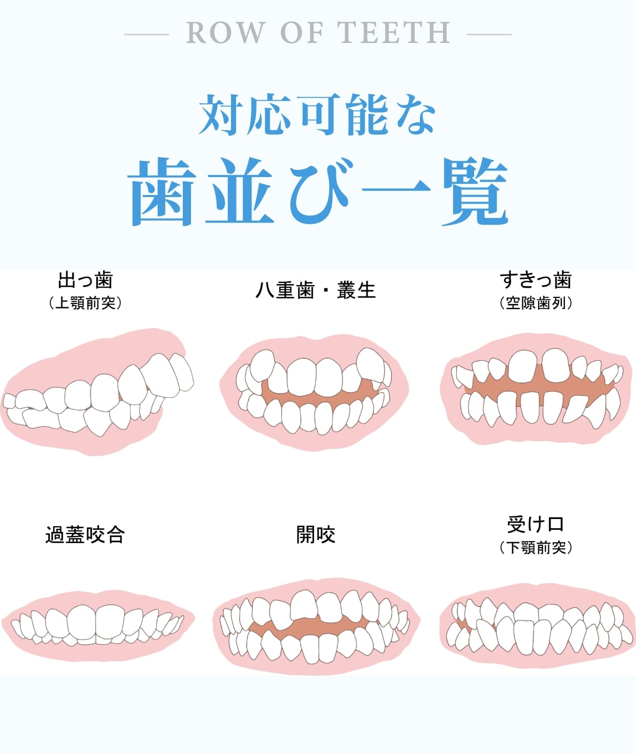 対応可能な歯並び一覧