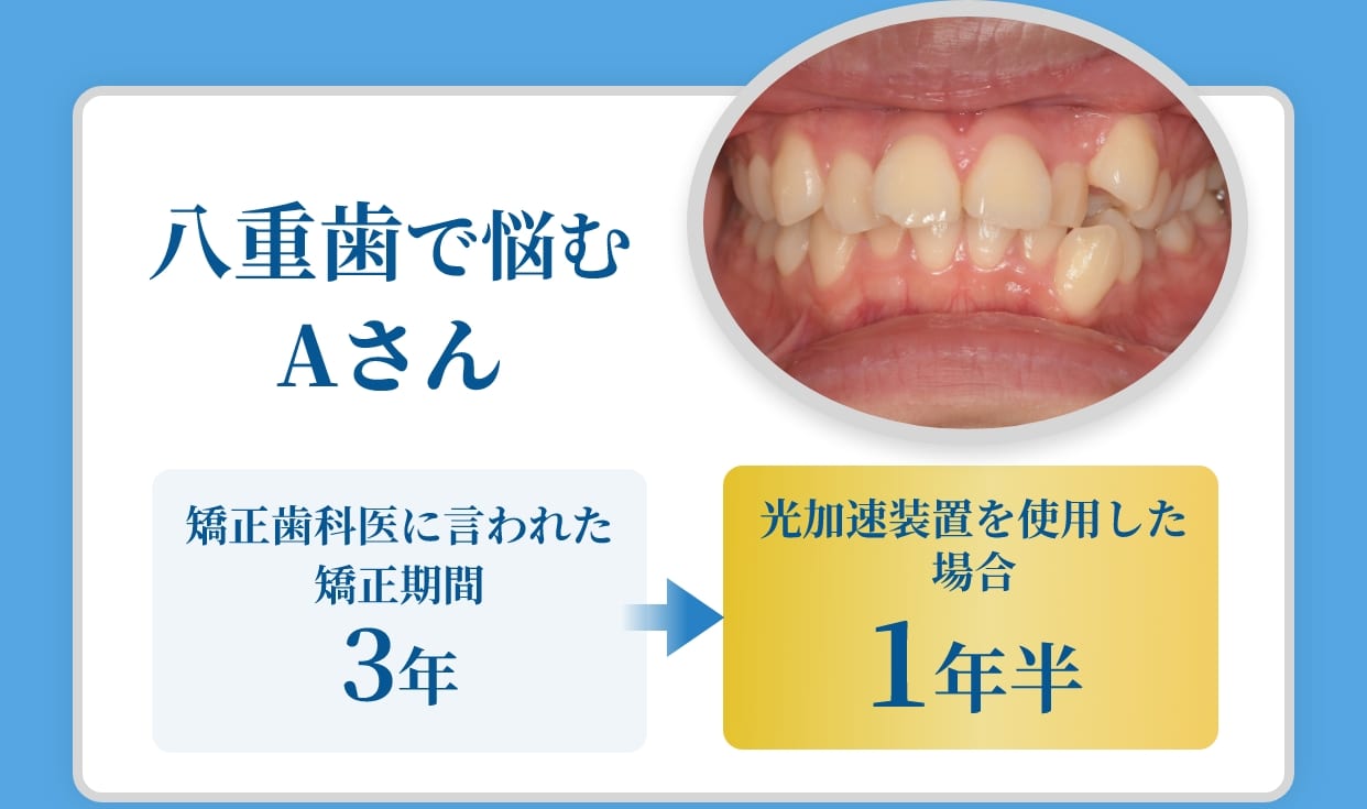 八重歯で悩むAさん矯正歯科医に言われた矯正期間3年。光加速装置を使用した場合1年半