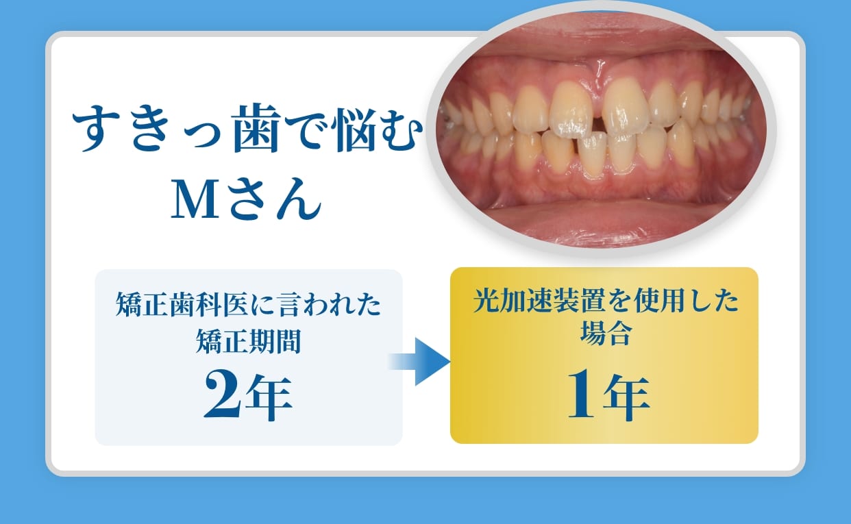 すきっ歯で悩むMさん矯正歯科医に言われた矯正期間18ヶ月。光加速装置を使用した場合9ヶ月