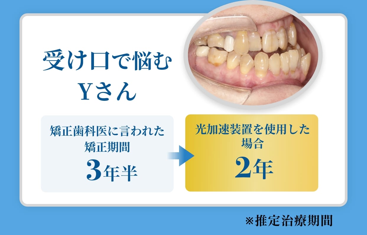 受け口で悩むYさん矯正歯科医に言われた矯正期間2年半。光加速装置を使用した場合1年