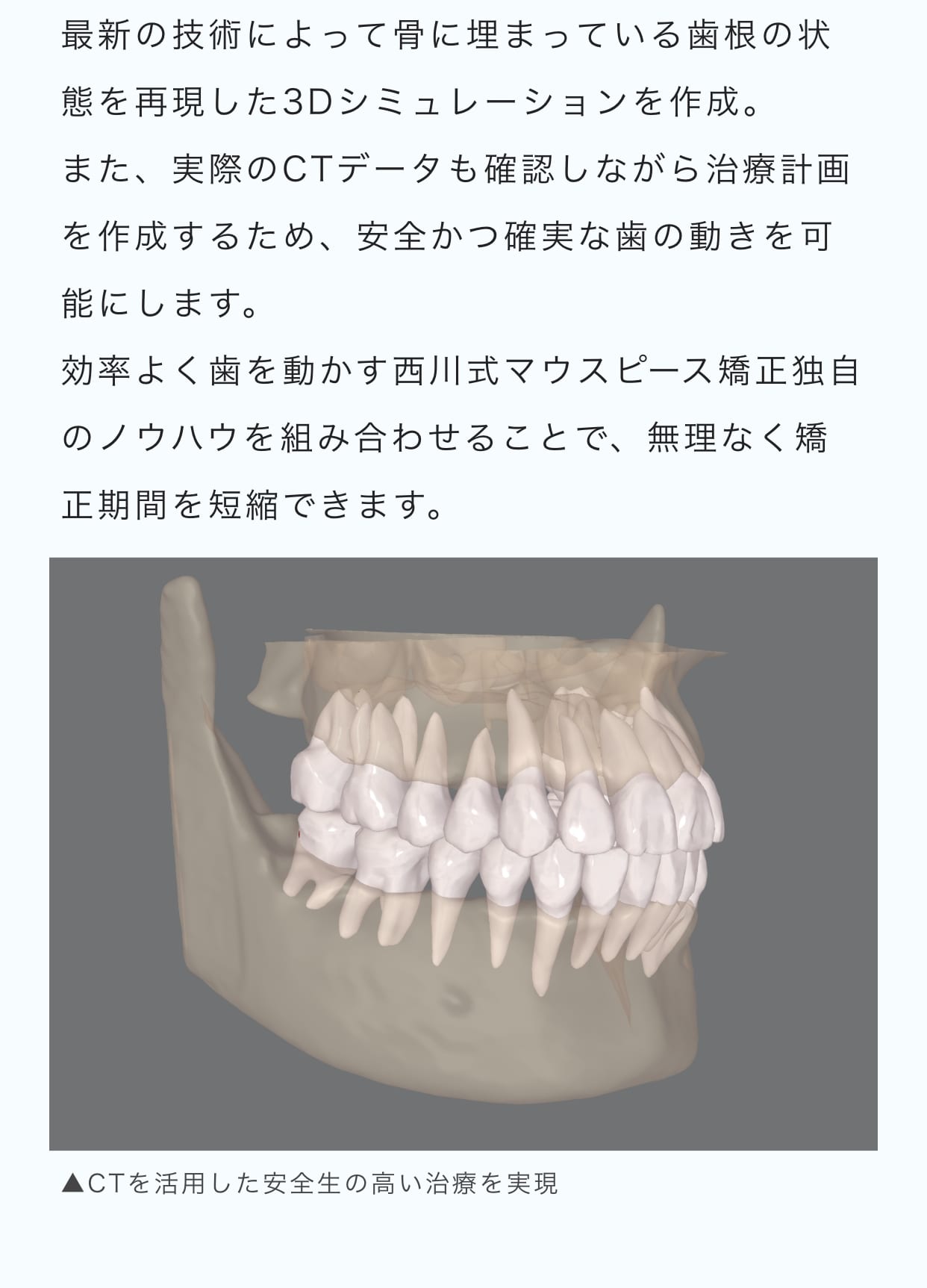 最新の技術によって骨に埋まっている歯根の状態を再現した3Dシミュレーションを作成。また、実際のCTデータも確認しながら治療計画を作成するため、安全かつ確実な歯の動きを可能にします。効率よく歯を動かす西川式マウスピース矯正独自のノウハウを組み合わせることで、無理なく矯正期間を短縮できます。