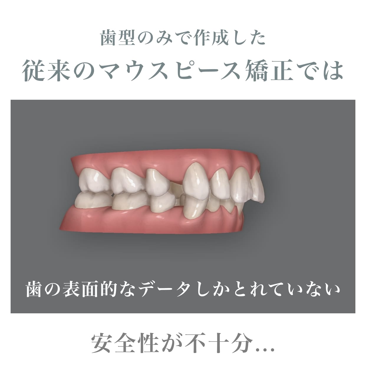 歯型のみで作成した。従来のマウスピース矯正では。歯の表面的なデータしか取れていない。安全性が不十分…